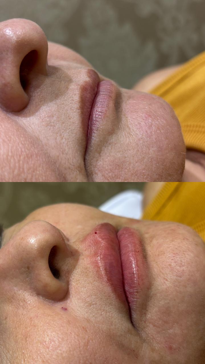 Preenchimento Labial